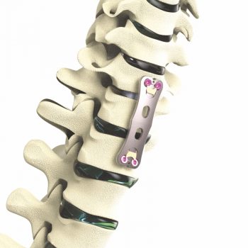 Apex Anterior Cervical Plate System