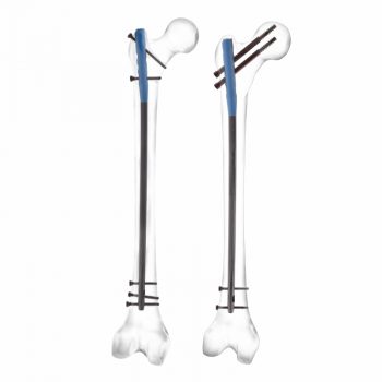 Expert Femoral Nailing System